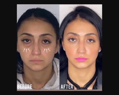 Facial Fat Transfer Before & After Gallery - Patient 192177 - Image 1