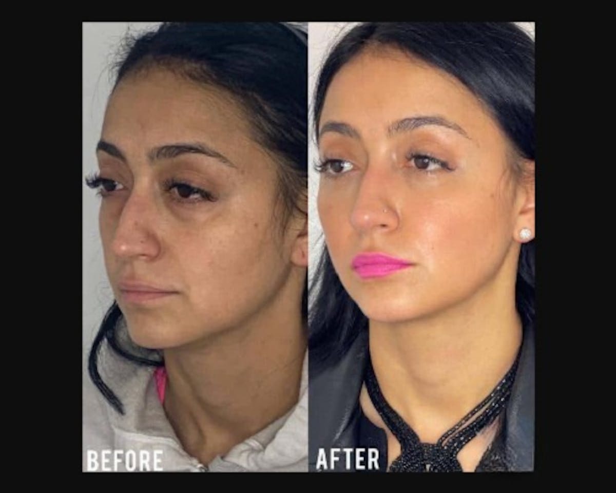 Lower Blepharoplasty Before & After Gallery - Patient 278359 - Image 2