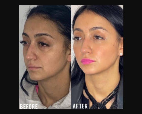 Lower Blepharoplasty Before & After Gallery - Patient 278359 - Image 2