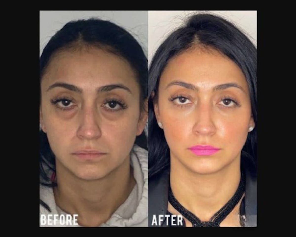 Lower Blepharoplasty Before & After Gallery - Patient 278359 - Image 4