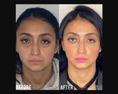 Lower Blepharoplasty Before & After Gallery - Patient 278359 - Image 4