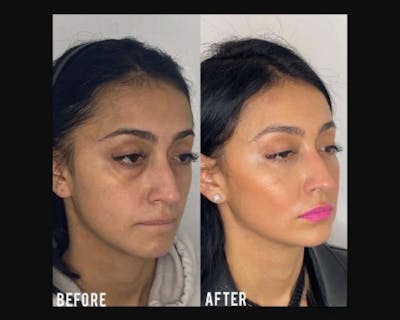 Lower Blepharoplasty Before & After Gallery - Patient 278359 - Image 3