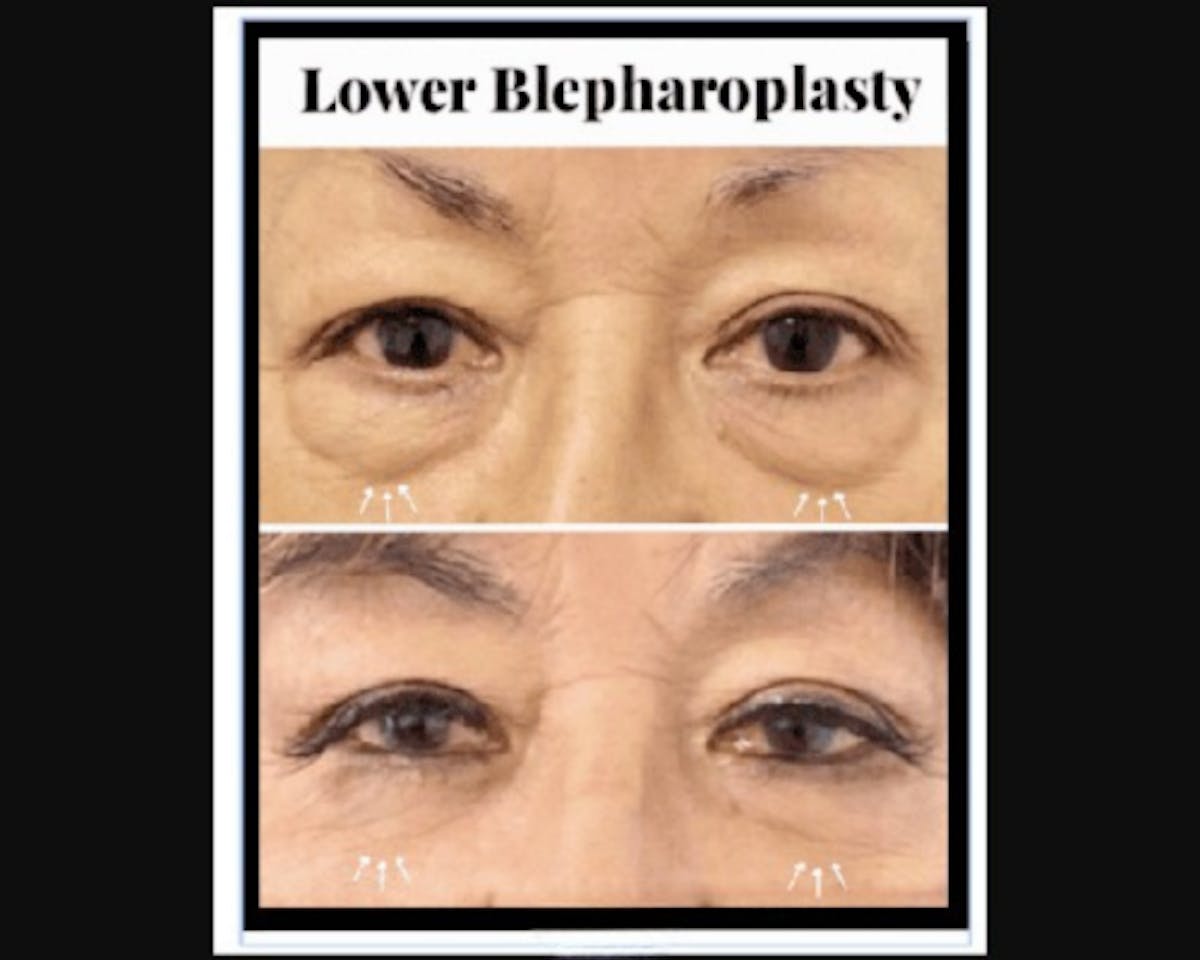 Lower Blepharoplasty Before & After Gallery - Patient 147930 - Image 2