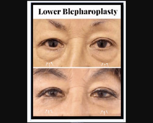 Lower Blepharoplasty Before & After Gallery - Patient 147930 - Image 2