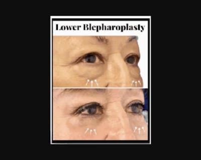 Lower Blepharoplasty Before & After Gallery - Patient 147930 - Image 3
