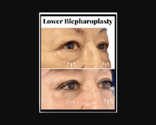 Lower Blepharoplasty Before & After Gallery - Patient 147930 - Image 3