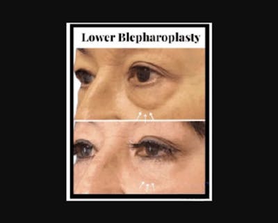 Lower Blepharoplasty Before & After Gallery - Patient 147930 - Image 1