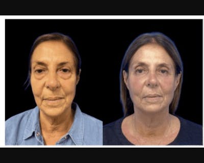 Lower Blepharoplasty Before & After Gallery - Patient 233810 - Image 1