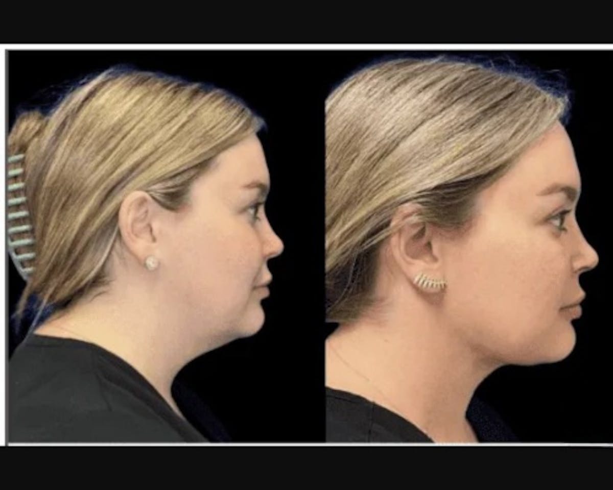 Chin & Neck Lipo Sculpting Before & After Gallery - Patient 353678 - Image 4