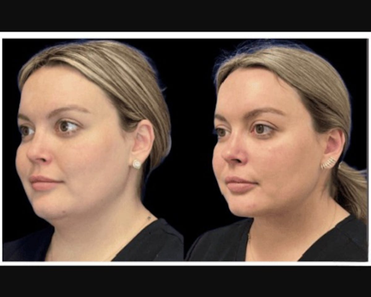 Chin & Neck Lipo Sculpting Before & After Gallery - Patient 353678 - Image 2