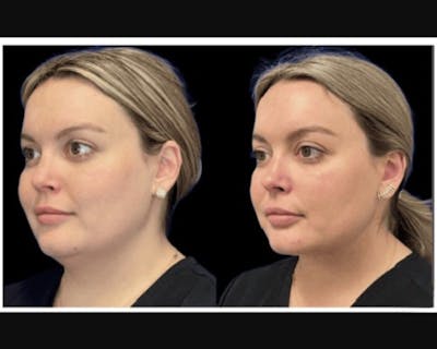 Chin & Neck Lipo Sculpting Before & After Gallery - Patient 353678 - Image 2