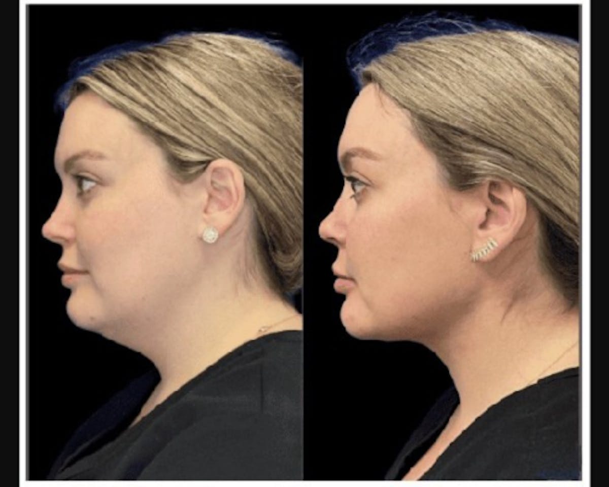Chin & Neck Lipo Sculpting Before & After Gallery - Patient 353678 - Image 1
