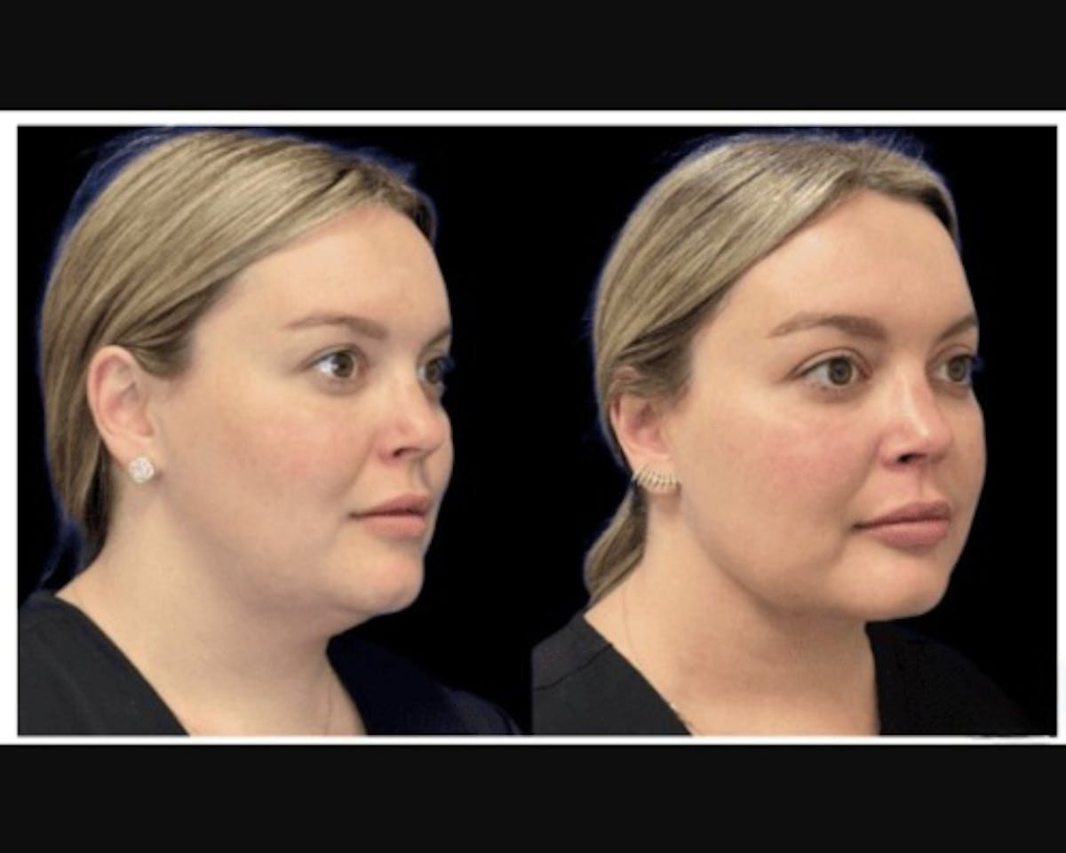 Chin & Neck Lipo Sculpting Before & After Gallery - Patient 353678 - Image 3