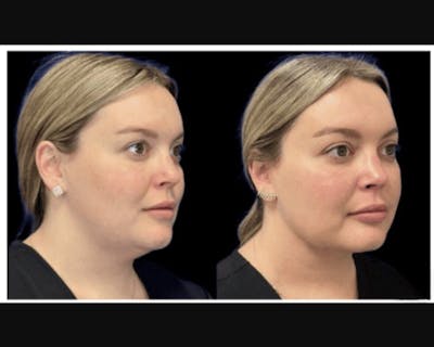 Chin & Neck Lipo Sculpting Before & After Gallery - Patient 353678 - Image 3