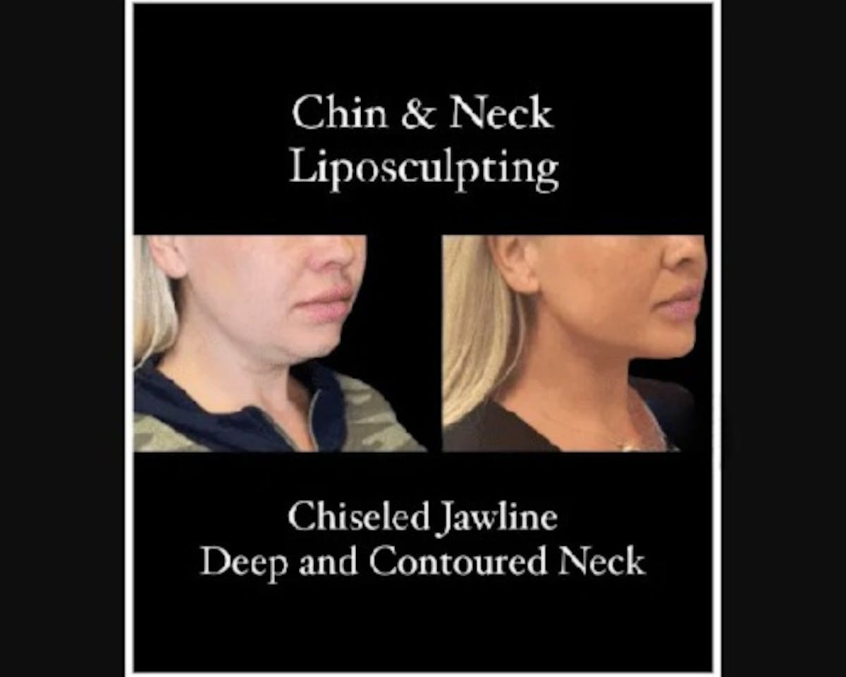 Chin & Neck Lipo Sculpting Before & After Gallery - Patient 426294 - Image 2