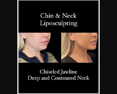 Chin & Neck Lipo Sculpting Before & After Gallery - Patient 426294 - Image 2