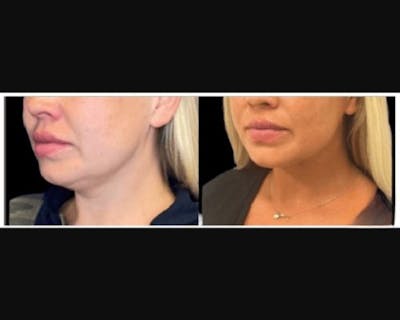 Chin & Neck Lipo Sculpting Before & After Gallery - Patient 426294 - Image 3