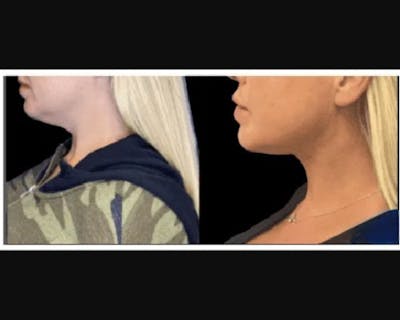 Chin & Neck Lipo Sculpting Before & After Gallery - Patient 426294 - Image 1