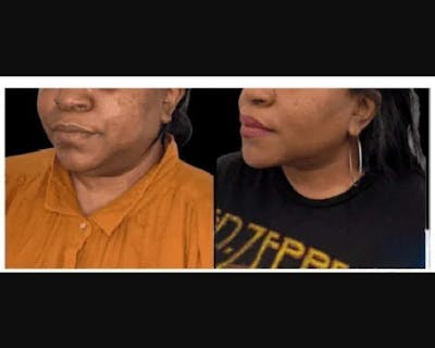Chin & Neck Lipo Sculpting Before & After Gallery - Patient 727911 - Image 2