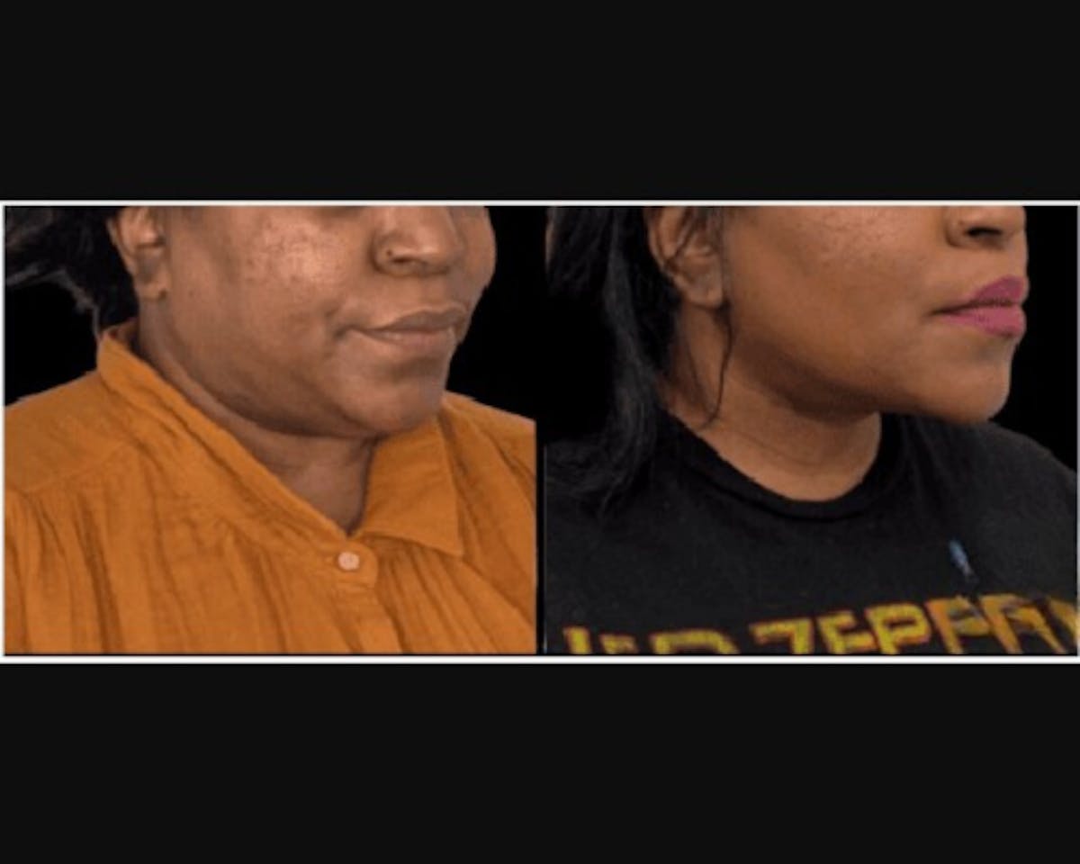 Facial Slimming Surgery Before & After Gallery - Patient 290053 - Image 1