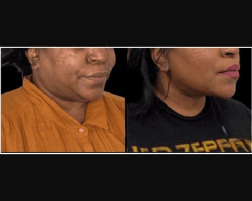 Facial Slimming Surgery Before & After Gallery - Patient 290053 - Image 1