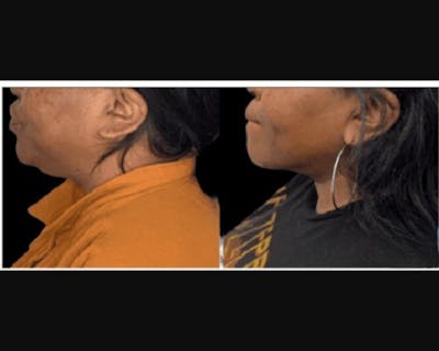Chin & Neck Lipo Sculpting Before & After Gallery - Patient 727911 - Image 1