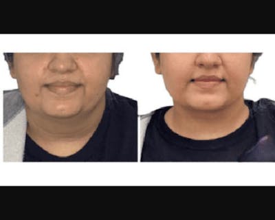 Buccal Fat Reduction Before & After Gallery - Patient 303556 - Image 1