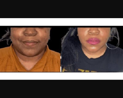 Buccal Fat Reduction Before & After Gallery - Patient 244776 - Image 1