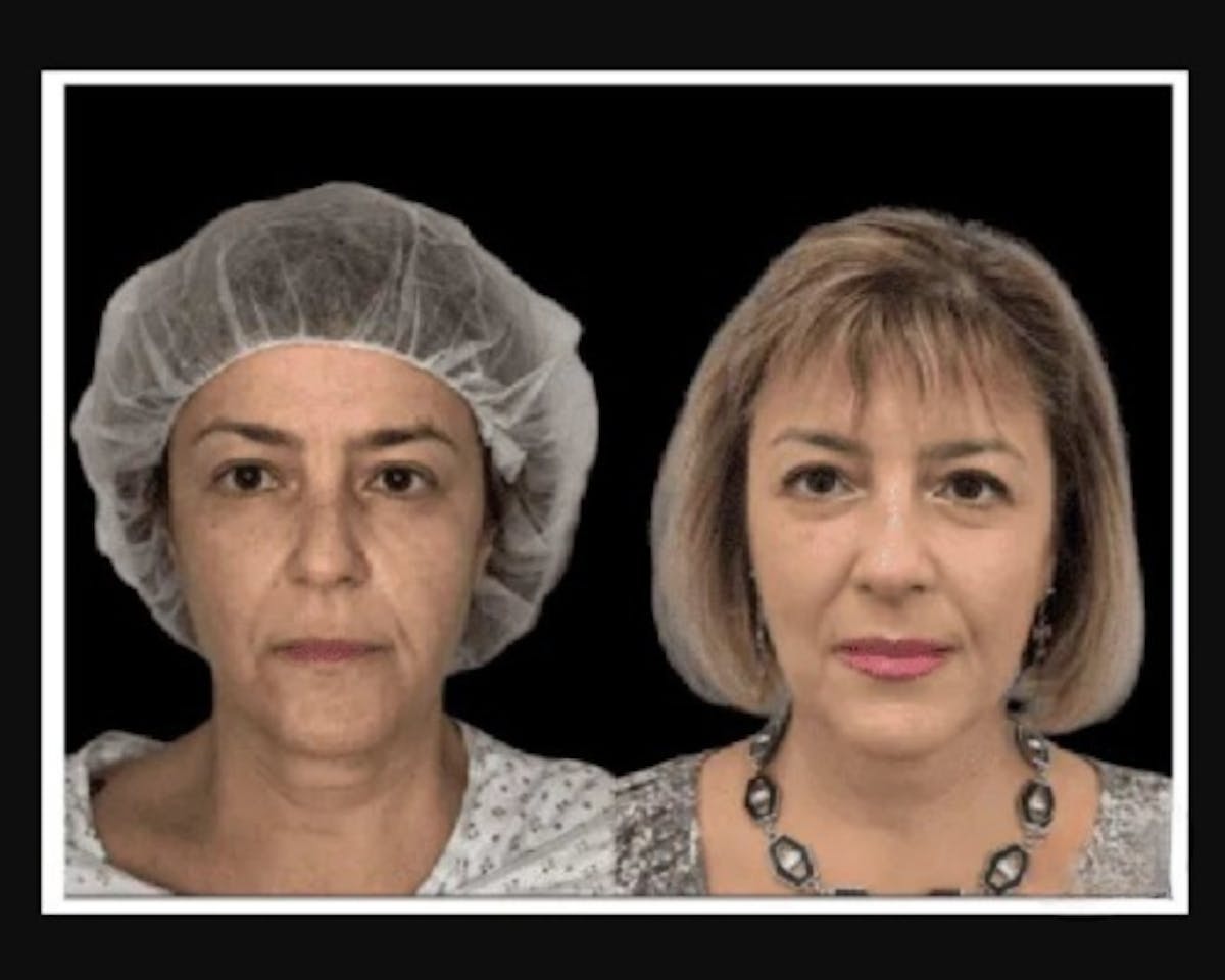  Facial Fat Transfer Before & After Gallery - Patient 117974 - Image 4