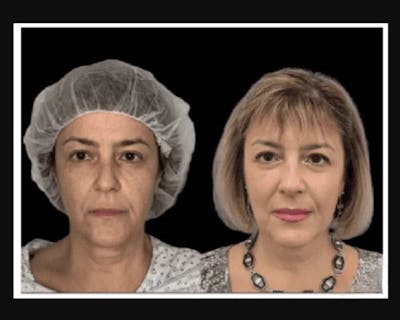 Facial Fat Transfer Before & After Gallery - Patient 117974 - Image 4