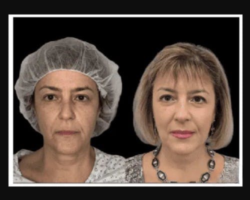 Facial Fat Transfer Before & After Gallery - Patient 117974 - Image 4