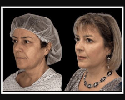 Facial Fat Transfer Before & After Gallery - Patient 117974 - Image 2