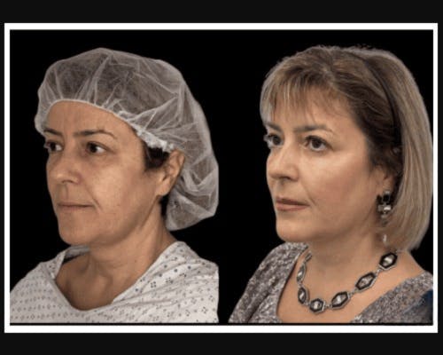 Facial Fat Transfer Before & After Gallery - Patient 117974 - Image 2