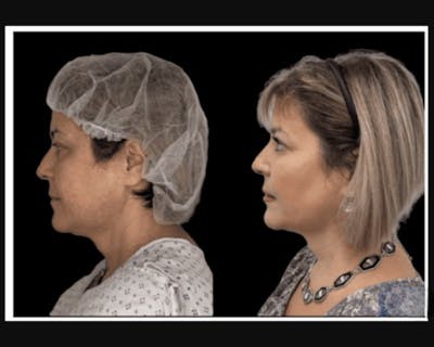 Facial Fat Transfer Before & After Gallery - Patient 117974 - Image 1