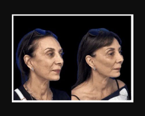 Facial Fat Transfer Before & After Gallery - Patient 322090 - Image 2