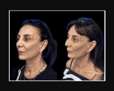 Facial Fat Transfer Before & After Gallery - Patient 322090 - Image 3