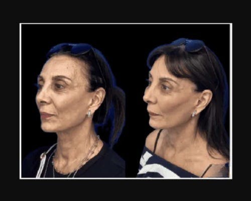 Facial Fat Transfer Before & After Gallery - Patient 322090 - Image 3