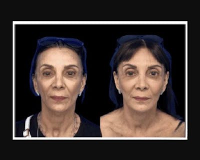 Facial Fat Transfer Before & After Gallery - Patient 322090 - Image 1