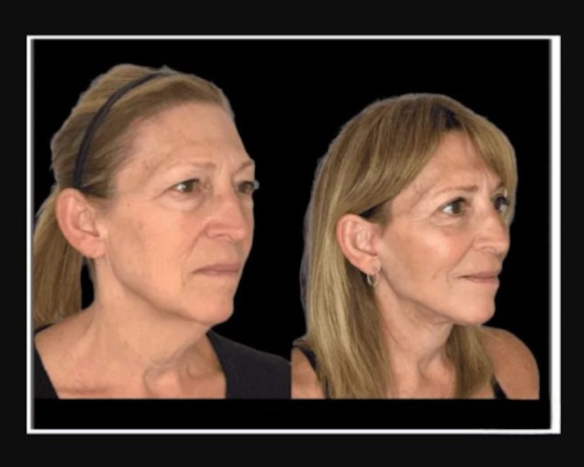  Facial Fat Transfer Before & After Gallery - Patient 284158 - Image 3