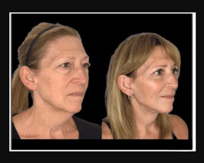 Facial Fat Transfer Before & After Gallery - Patient 284158 - Image 3
