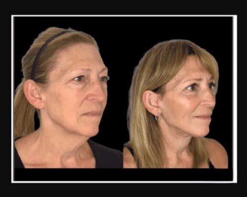 Facial Fat Transfer Before & After Gallery - Patient 284158 - Image 3