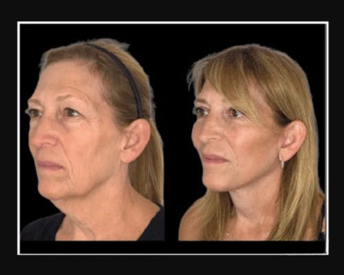 Facial Fat Transfer Before & After Gallery - Patient 284158 - Image 2