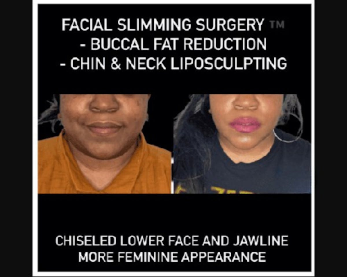 Facial Slimming Surgery Before & After Gallery - Patient 290053 - Image 2