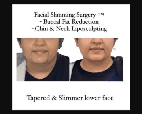 Facial Slimming Surgery Before & After Gallery - Patient 299148 - Image 4