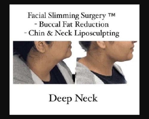 Facial Slimming Surgery Before & After Gallery - Patient 299148 - Image 2