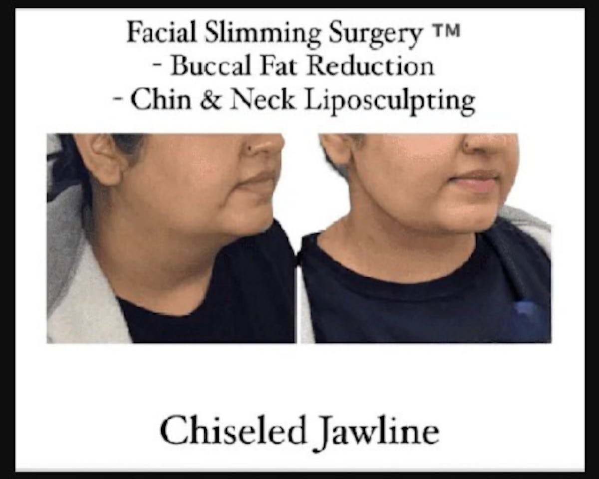 Facial Slimming Surgery Before & After Gallery - Patient 299148 - Image 1