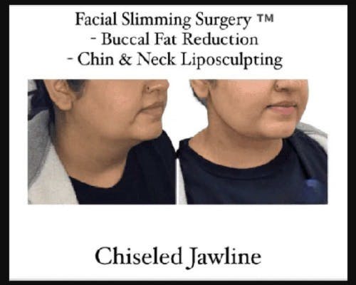 Facial Slimming Surgery Before & After Gallery - Patient 299148 - Image 1