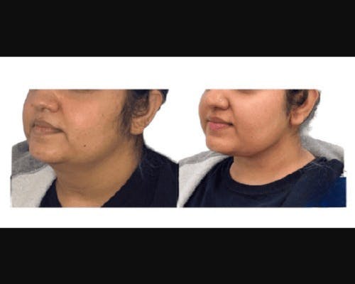 Facial Slimming Surgery Before & After Gallery - Patient 299148 - Image 3