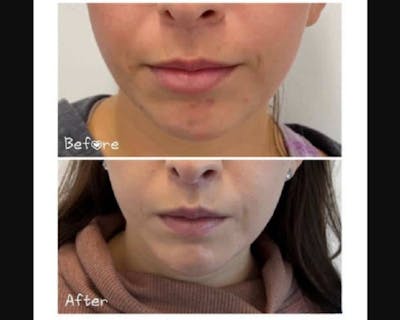Lip Lift Before & After Gallery - Patient 651929 - Image 1
