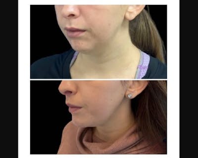 Chin Implant Before & After Gallery - Patient 304145 - Image 4
